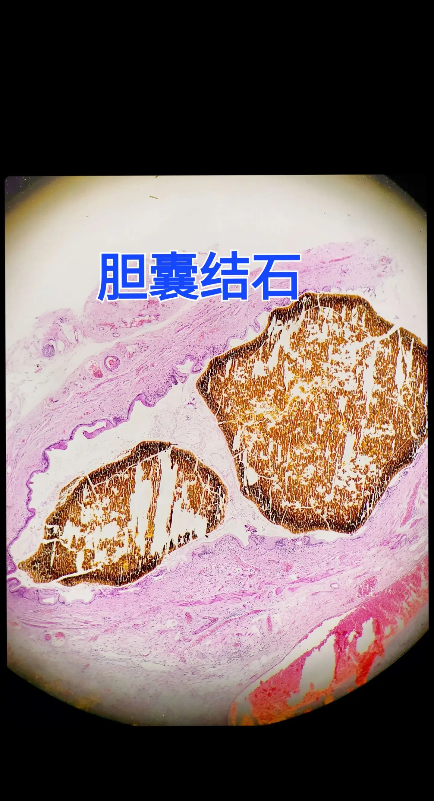 胆囊结石