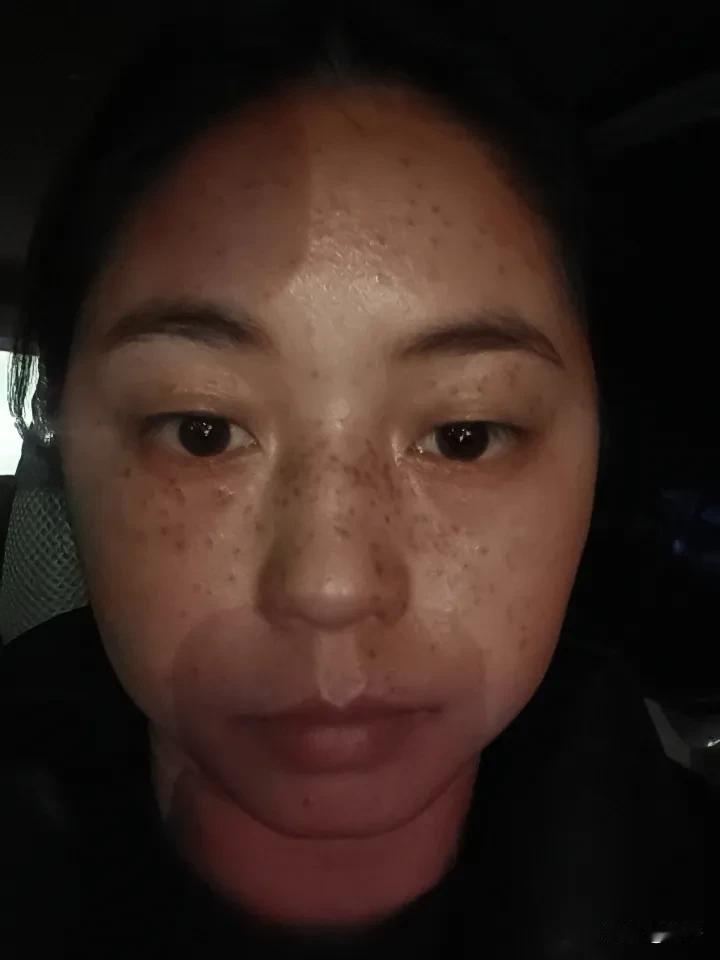 做完皮秒祛斑第二天的效果