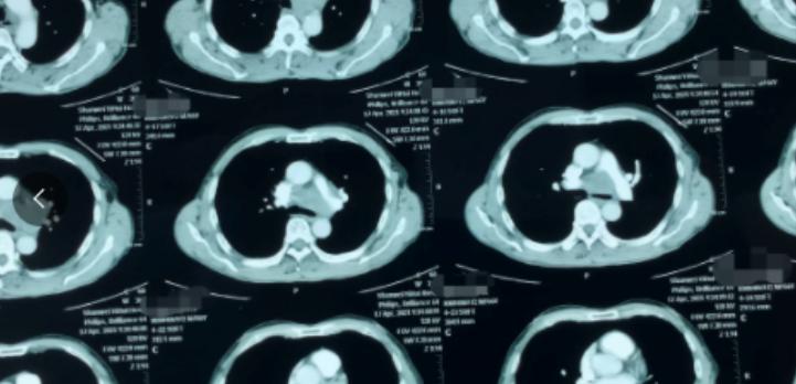 患者半年前 CT 体检完全正常，仅仅半年后再检查，就已是肺癌晚期。这种情况在我临