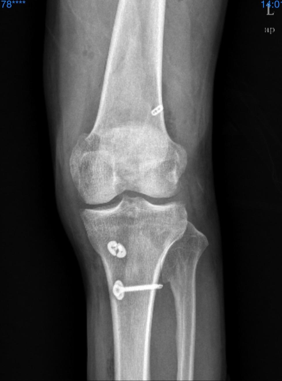 前交叉韧带重建术后影像评估。
