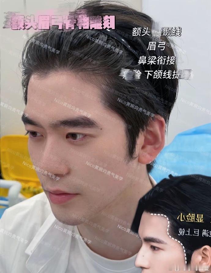 赵樱子弟弟整成张凌赫了赵樱子弟弟做了张凌赫同款鼻子 赵樱子弟弟做了张凌赫额结节+