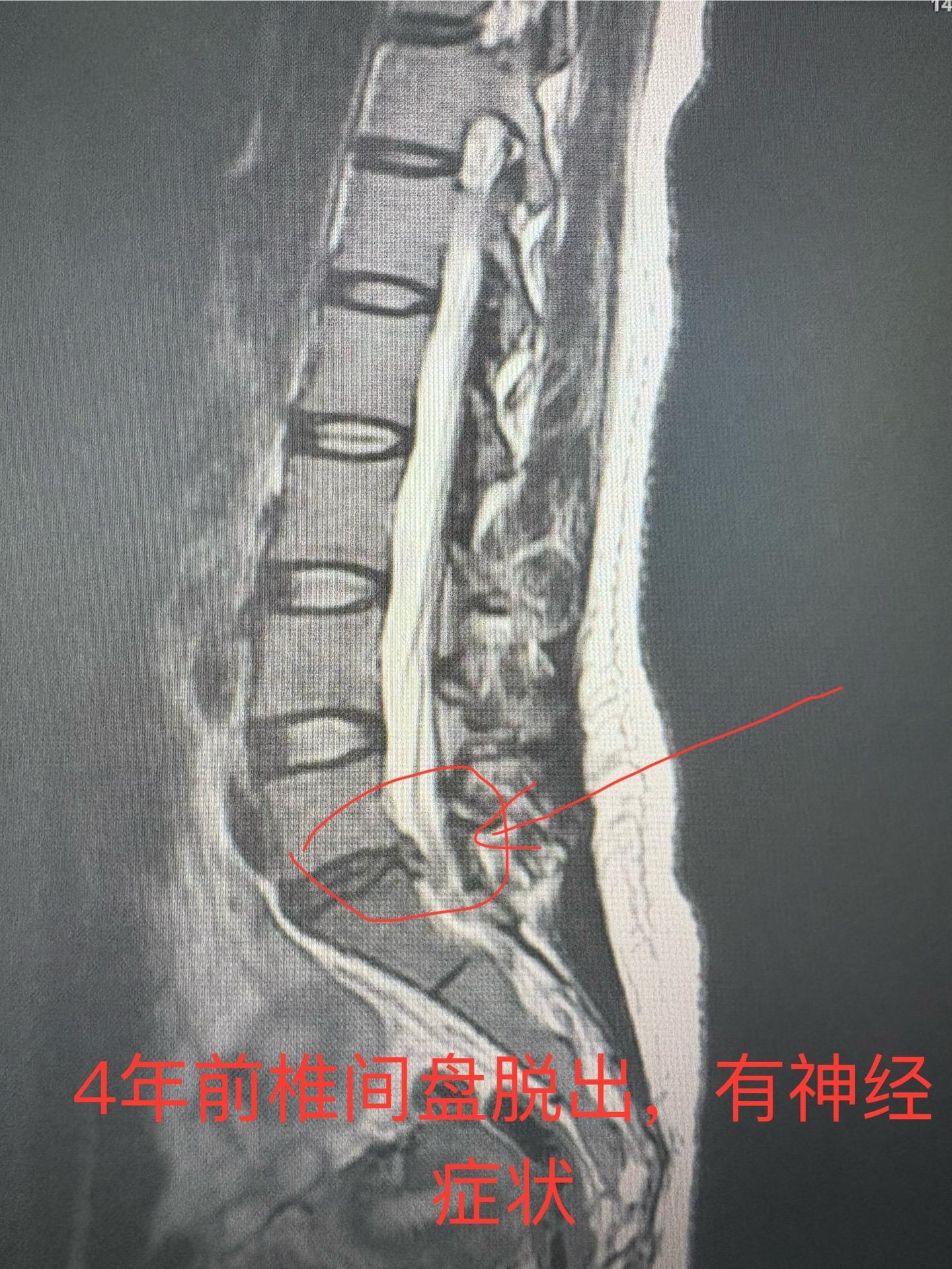 椎间盘脱出了能不能保守治疗？今天碰到一个病例，四年前椎间盘脱出，选择保...