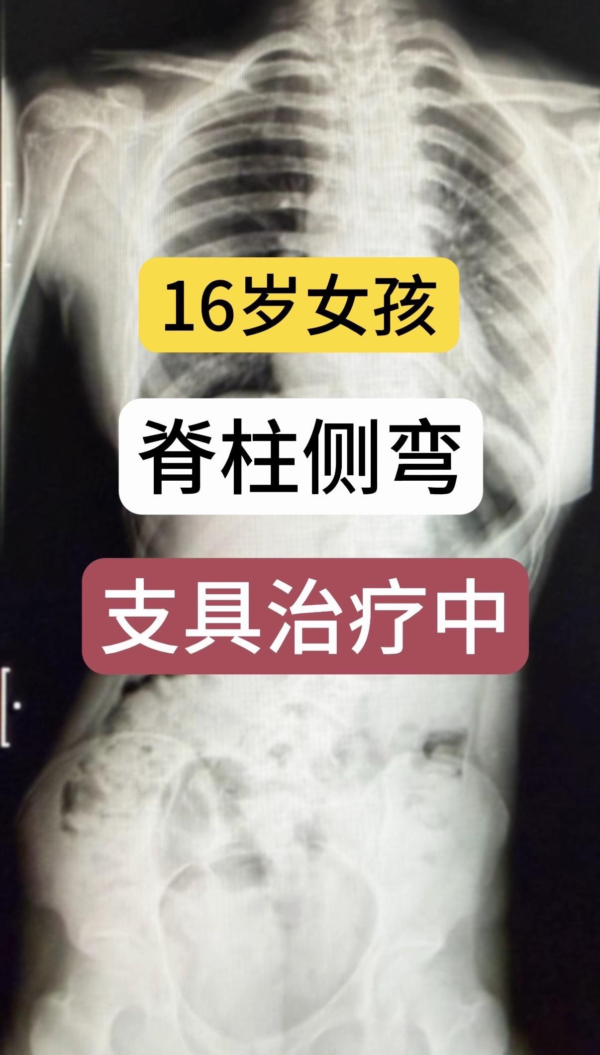 16岁女孩，脊柱侧弯，支具治疗中。支具矫形效果好