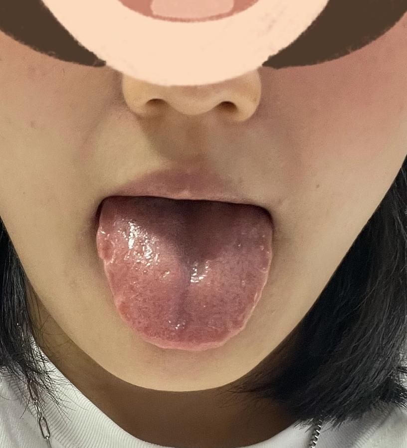 明明齿痕这么深，还夹杂个肝郁，真还很难调[皱眉][皱眉][皱眉]
像这女孩子天天