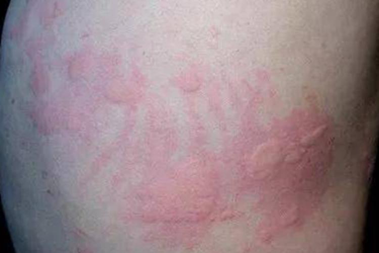 你知道‘鬼风疙瘩’吗？其实它就是‘荨麻疹’。
这个鬼风疙瘩，看似是皮肤问题，而实