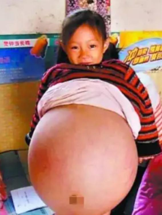2010年，山西4岁女孩胡云星，肚子超大鼓胀得像孕妇。医生预言活不过三个月，就在