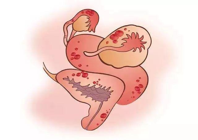 #健康真探社#【盆腔有积液，严重吗？】盆腔积液意味着盆腔内有一定量的液体，类似皮