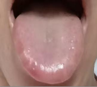 舌苔厚重伴裂纹、畏寒怕冷、大便稀溏，男士各类体虚不适，根源多是脾肾阳虚



