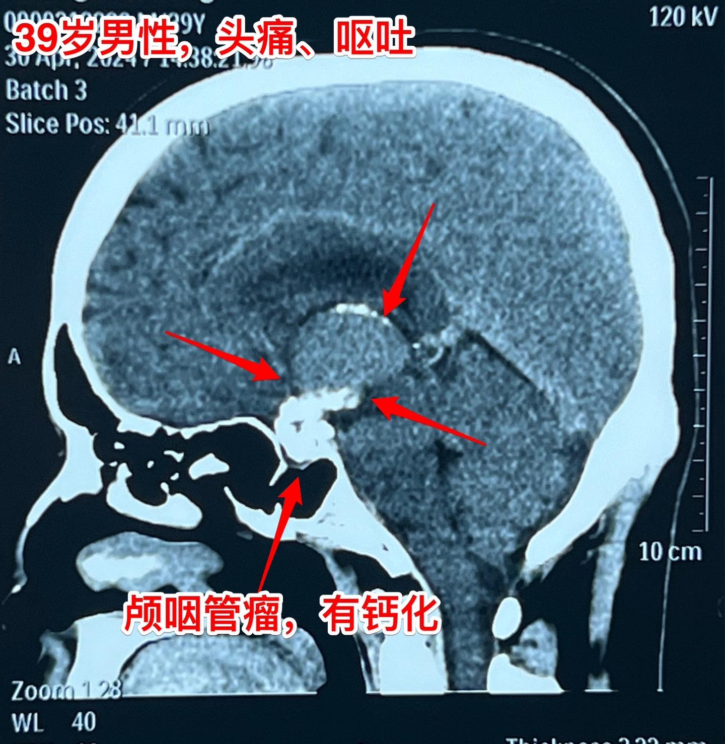 五月六日的颅咽管瘤手术。山西省男性，39岁，因为头痛、呕吐在4月29日就急匆匆的赶到三博脑科医院来住院。病因是颅咽管瘤造成颅压高，不能正常吃东西了。住院后用药物治疗，头痛症状减轻，也不呕吐，能正常进食。从图片可以看出这个颅咽管瘤属于细长型，从垂体窝延伸到第三脑室内，垂体窝里有大块钙化，手术是有难度的。
        五一假期一过就排上手术，顺利切除肿瘤，手术后CT结果很让人满意，希望肿瘤不复发。
