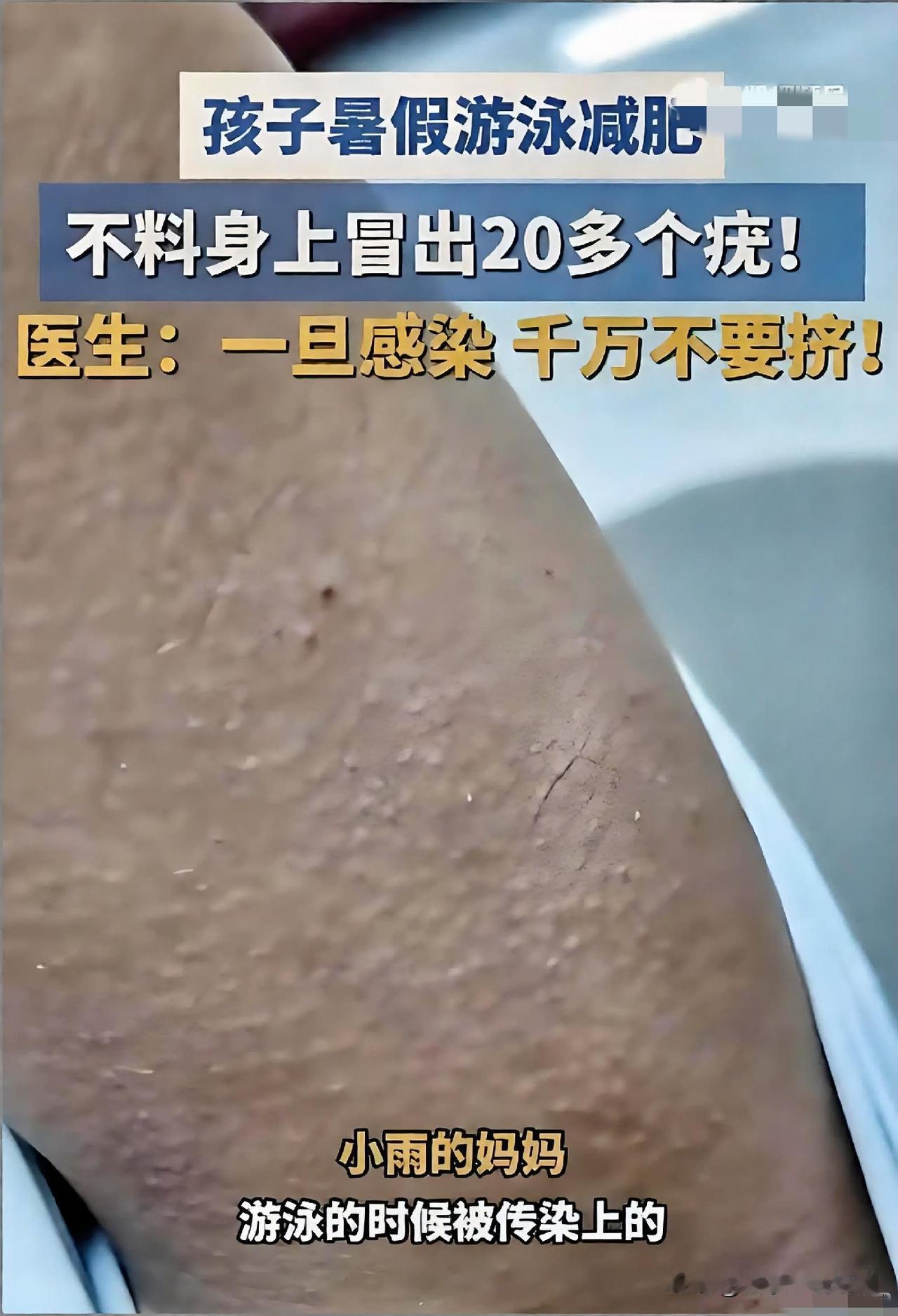 河南女孩小雨暑假连着游了二十多天泳，想靠运动减肥，没成想身上悄咪咪冒出二十多个不