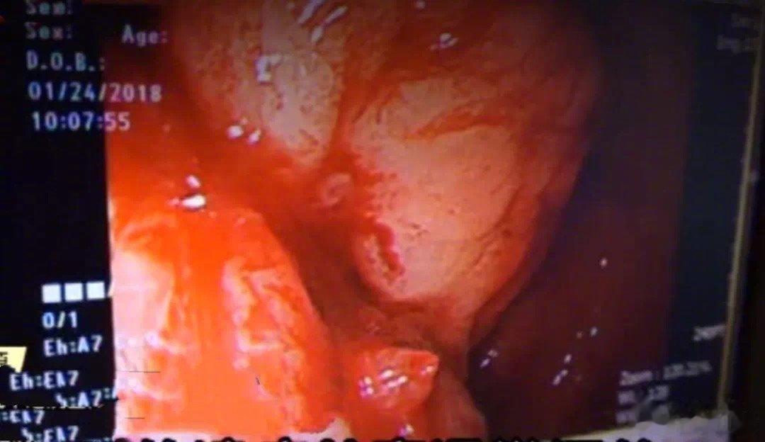 吃药时很多人都有的这种习惯，其实很危险！2018年1月23，某位男大学生因为感冒