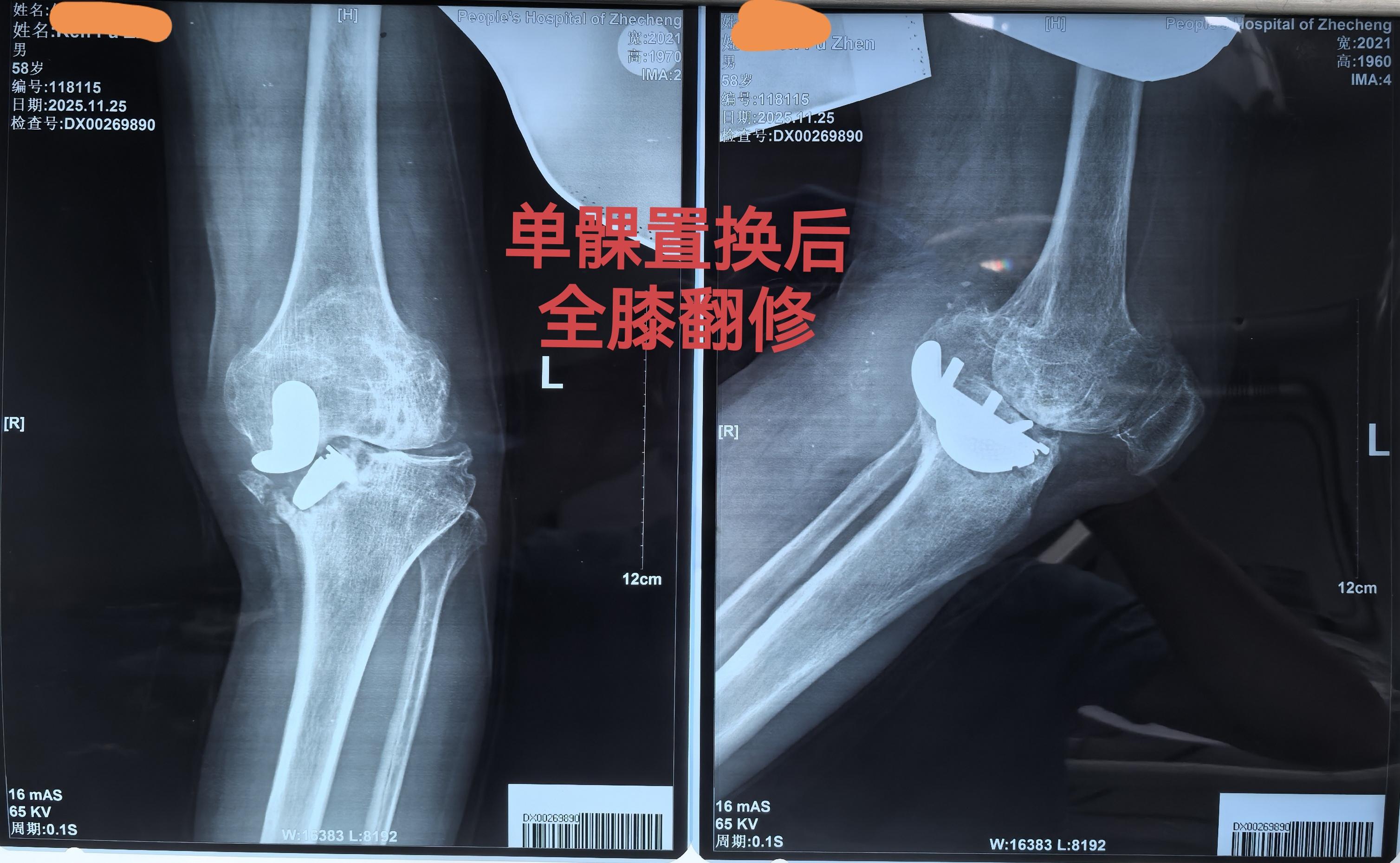 单髁置换术后全膝翻修。单髁置换术后假体松动，双侧全膝翻修。还是那句话...
