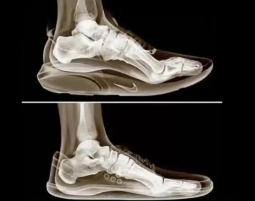 青少年一定要慎穿“碳板鞋”！很多孩子跟风购买的碳板鞋或成“毁脚利器”，长期穿会出