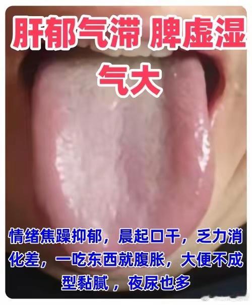 舌诊1.肝郁气滞 脾虚湿气大症状：情绪焦躁抑郁，晨起口干，乏力消化差，一吃东西就