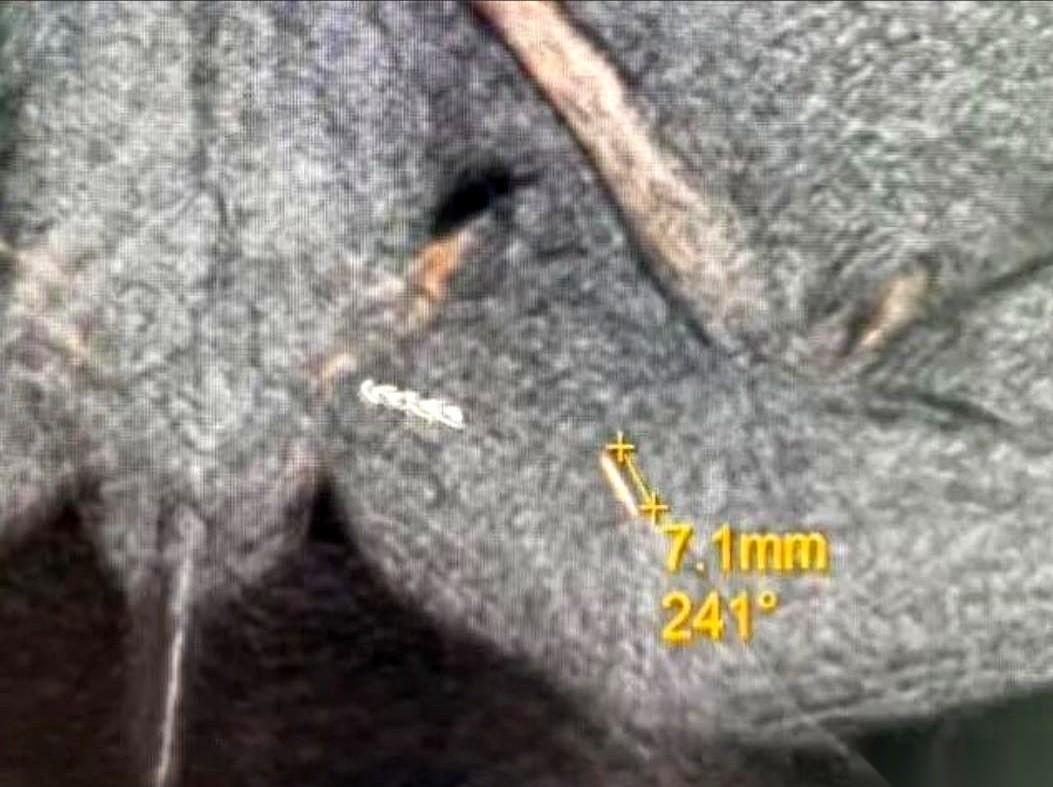 两年，整整两年啊。
所有人都跟她说，阿姨，你想多了，你这是心理作用。
一个62岁