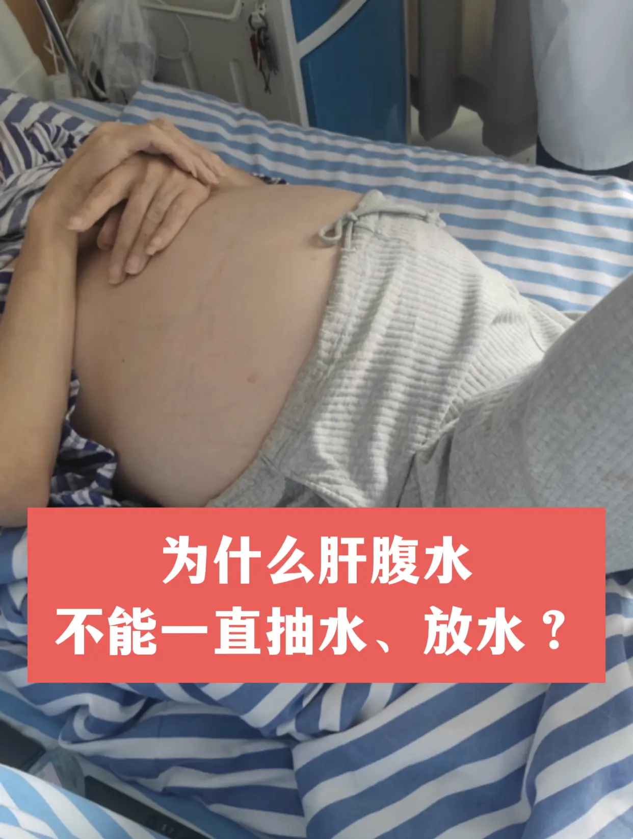 58岁的肝硬化患者，肚子胀得厉害，白蛋白低到 22，腹水 10 多公分...