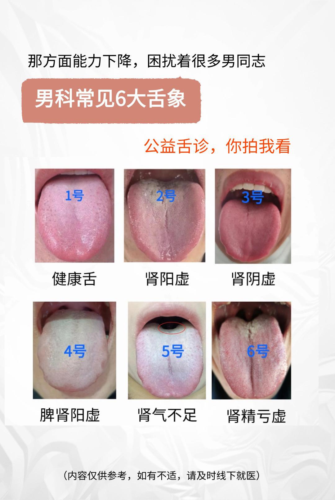 公益舌诊第49天！你拍我看，一分钟出结果！
1号：舌红润，健康舌象
2号：肾阳虚