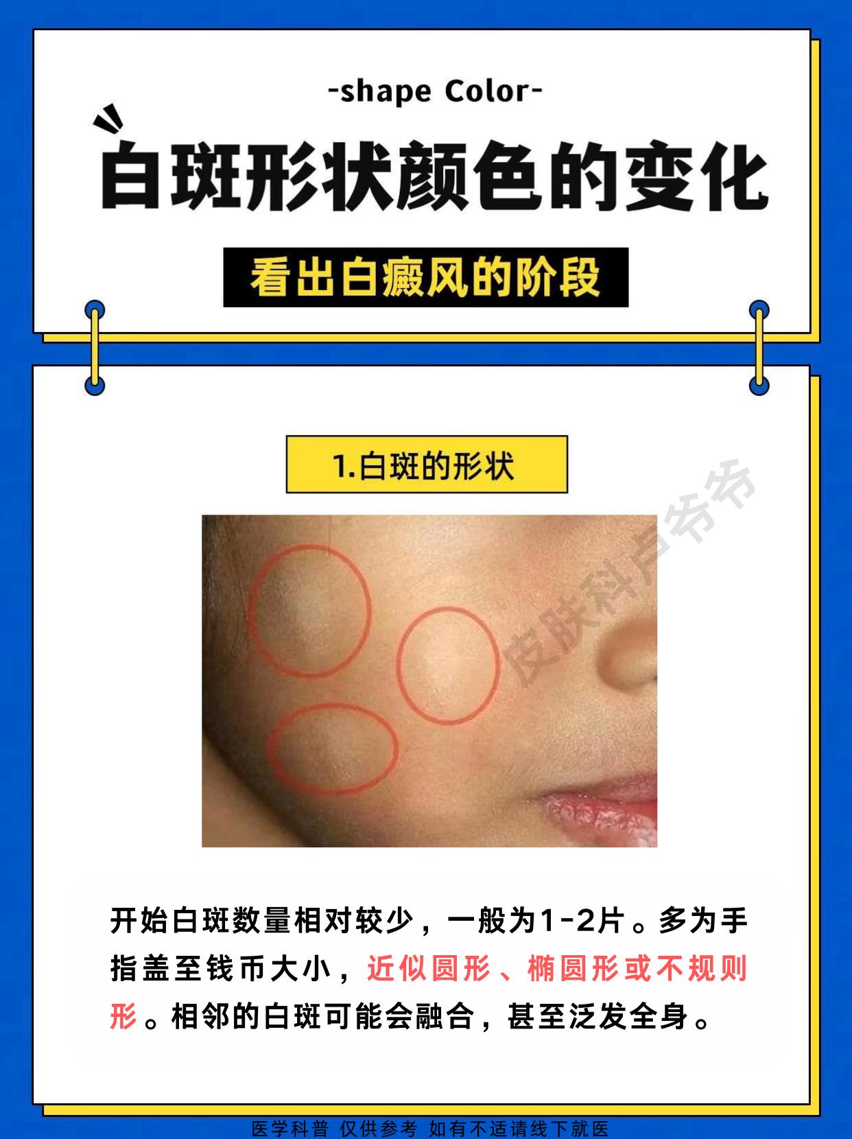 四张图教你辨别白癜风