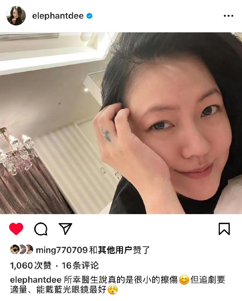 小S的眼睛没事，还可以追剧，但是要少看，医生说是很小的擦伤。而今天上节目录制，还