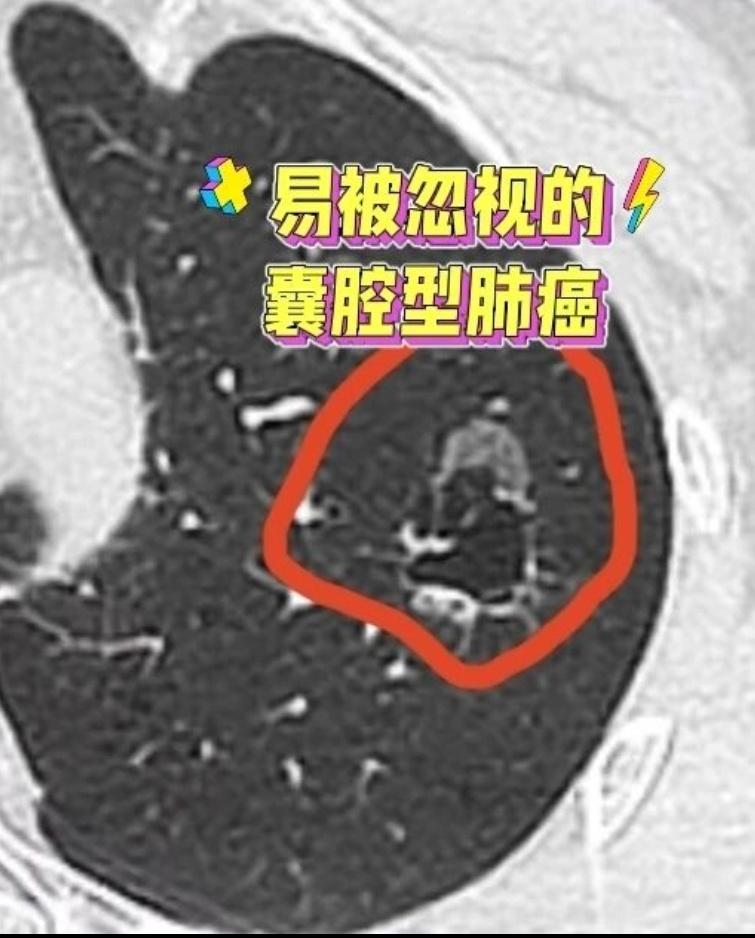 别被“肺囊肿”欺骗了。很多人做过胸部CT，当看到报告上写着肺囊肿、肺大...