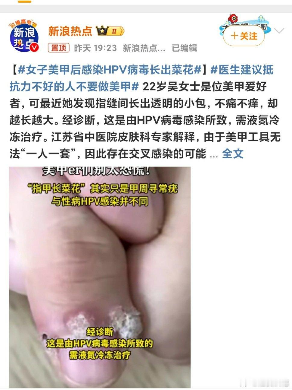 女子美甲后感染HPV病毒长出菜花 平时一定要加强防护，现在疯毒真的多，防不胜防。