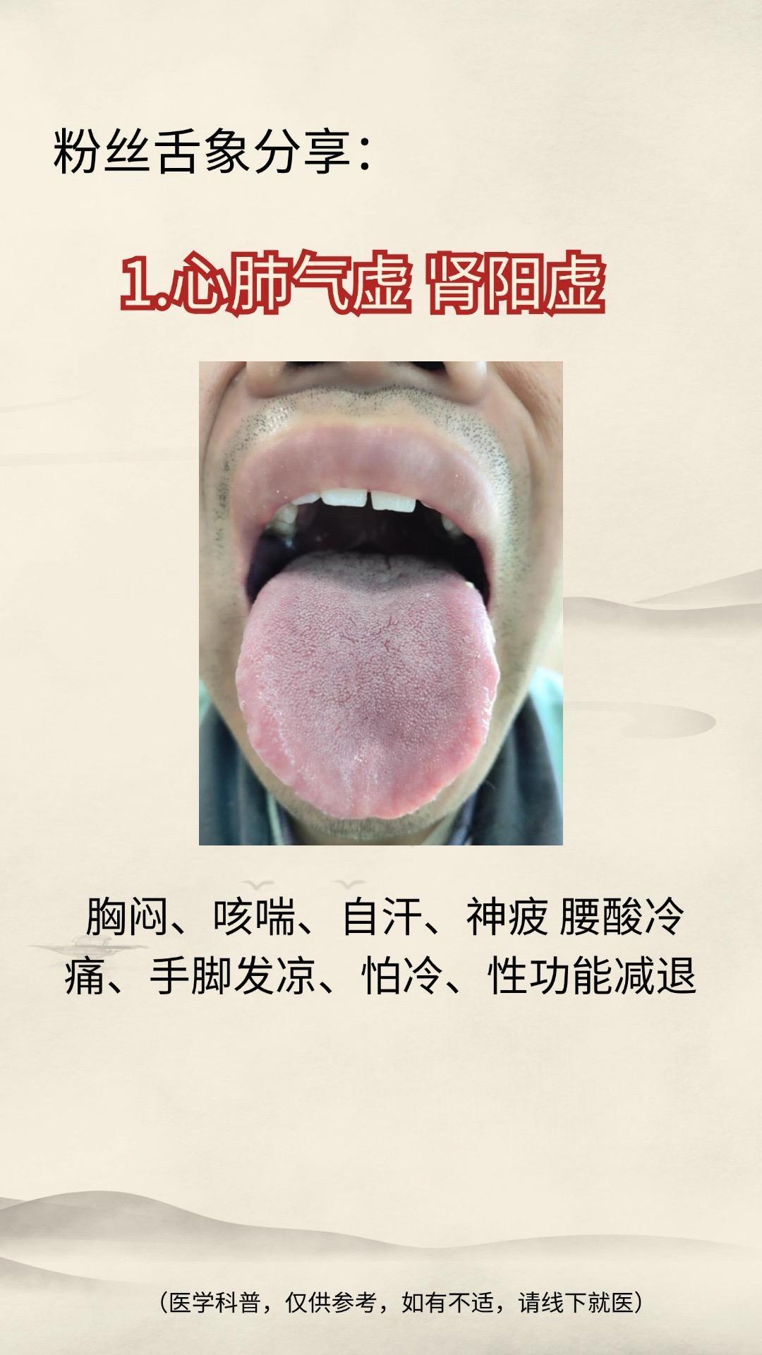 1.心肺气虚 肾阳虚
2.脾肾阳虚 湿气重
3.脾虚 痰湿重
那你的舌头是哪种情