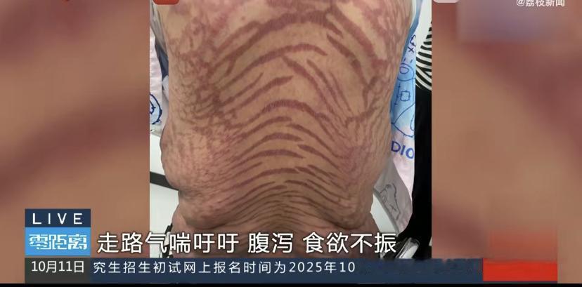 江苏一位王阿姨，可被“网红神膏”给坑惨了。
十年前，她小腿上只是有点发痒、起红斑