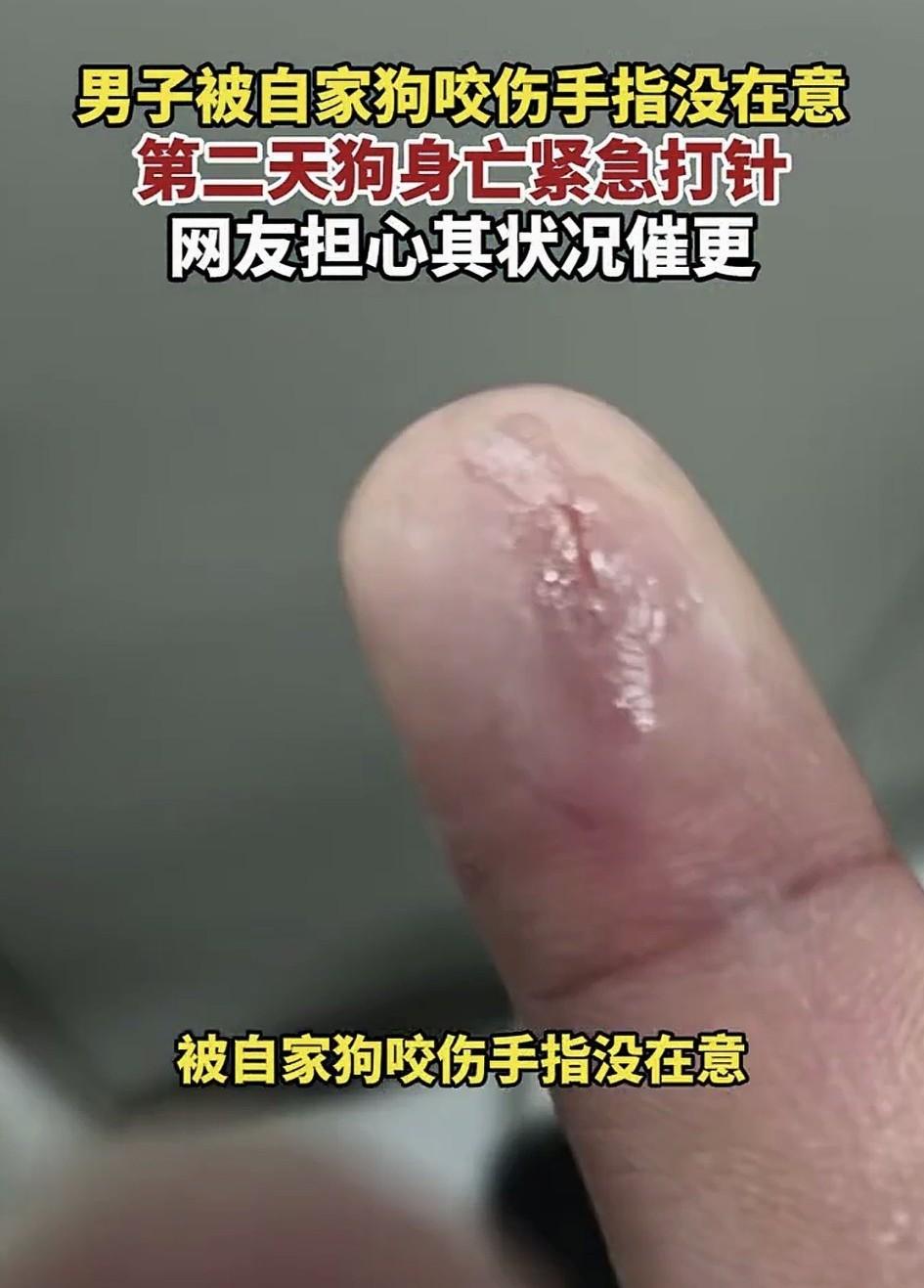 河南周口的李先生被自己养了半年的狗咬了手指，当时就破了点皮，他没当回事。没洗伤口