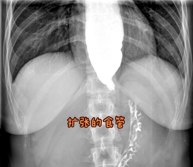 贲门失弛缓。女，36岁，进食梗阻1年余，诊断贲门失弛缓症，行POEM(经口内镜下肌切开术)。