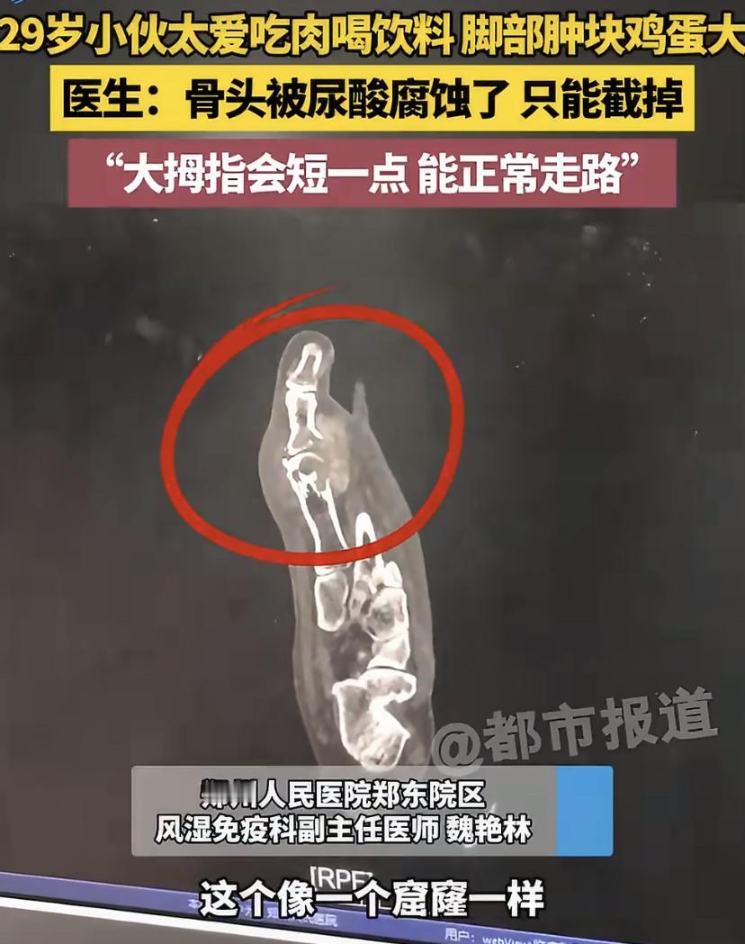 河南28岁的张先生，因为常年把饮料当水喝，顿顿离不开肉，20岁就被痛风缠上。八年