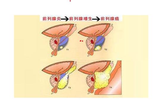一个补、消、清、补肾益阳、活血化瘀，清除体内湿浊，尿频、尿急、尿痛等症状逐一消失