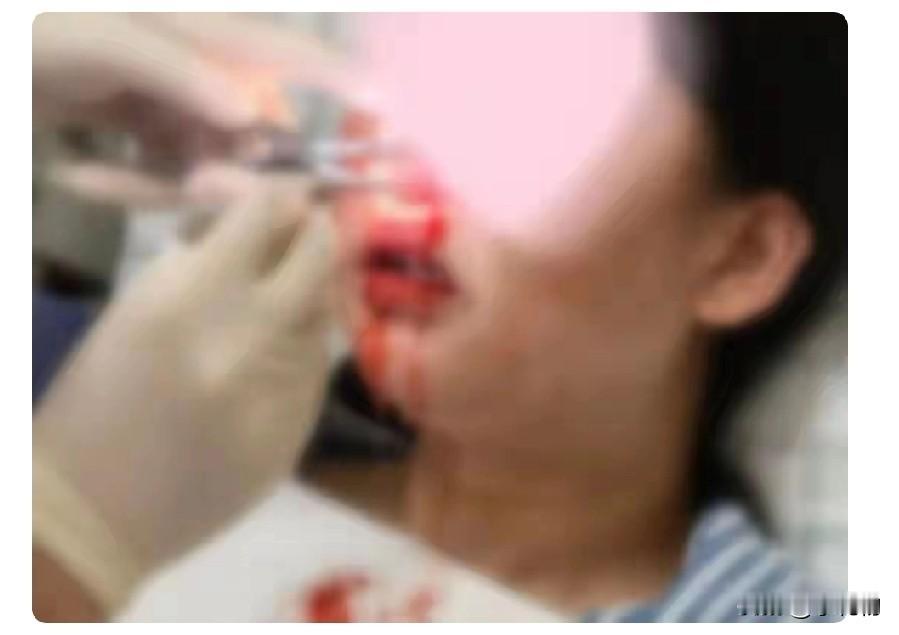 后怕！孕35周孕妈流鼻血，竟查出鼠药中毒😱
 
深圳孕35周的邓女士突然流鼻血