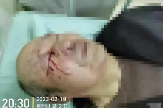 2023年73岁老兵被养老院护工打爆眼球，院方：我们是日本管理理念

【来源：海