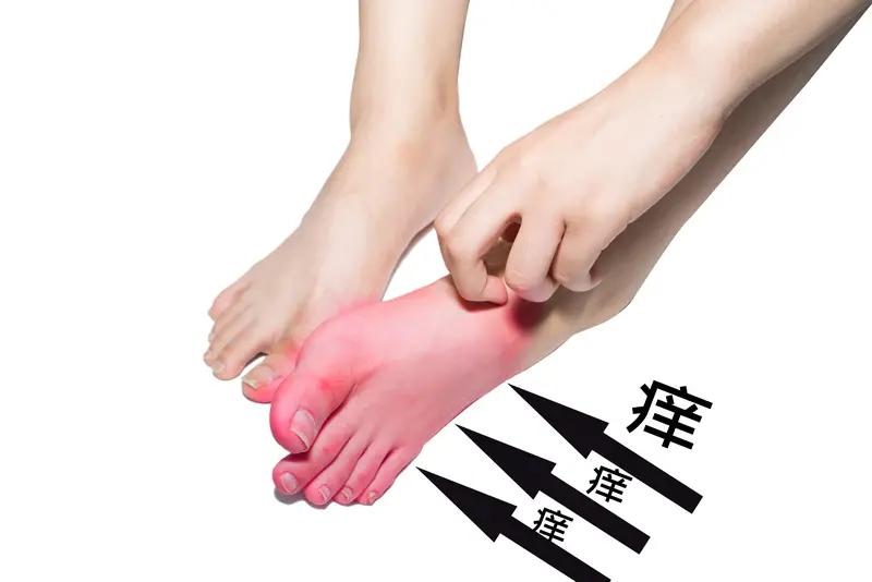 痛风这病真让人头疼，到底能不能彻底治好，还真不好说。
痛风是尿酸盐结晶沉积在关节