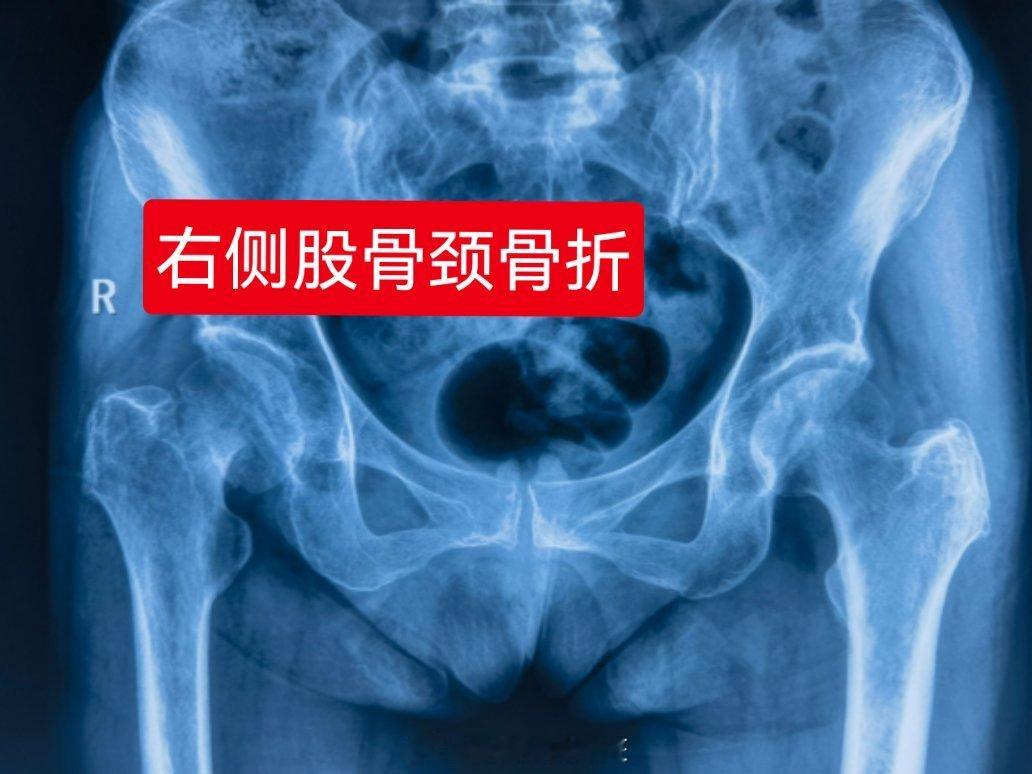 65岁老太太右侧股骨颈骨折，儿子从我手术的老病号那里打听到我电话，下午联系之后立