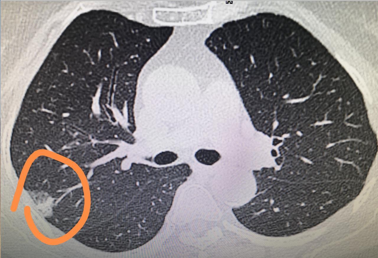 [心]肺结节的6种描述，这次教会你看！会看了不用四处求人！
描述1：边界清
多是