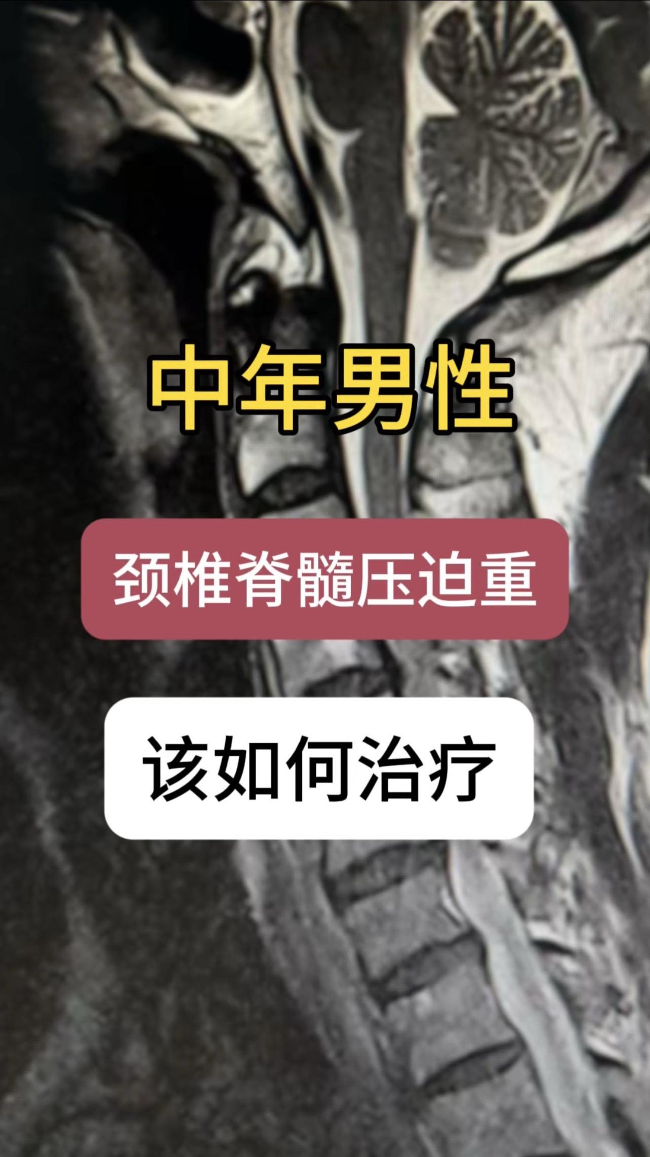 50多岁男性，四肢麻木，双下肢无力1年，加重2月，左侧重。术前显示颈椎...
