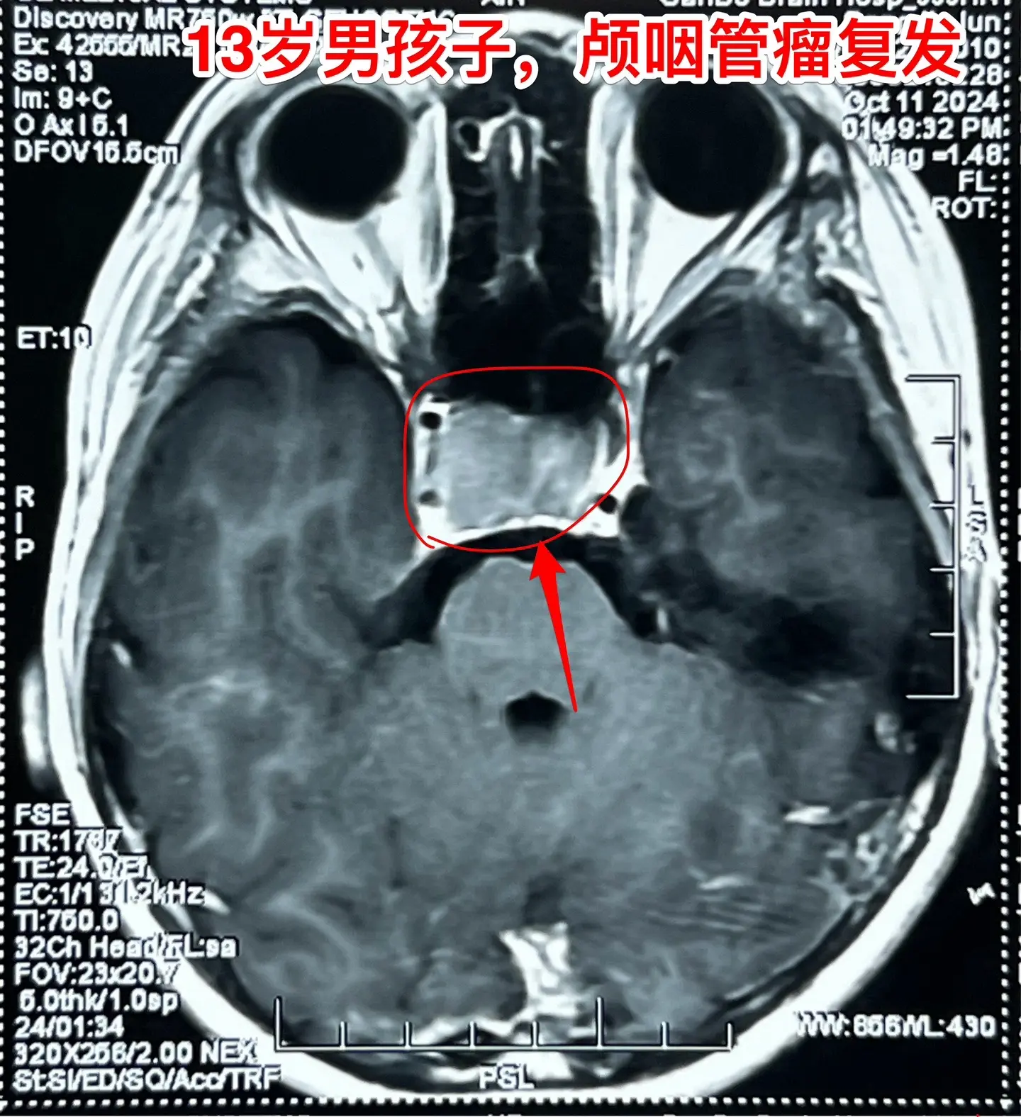 鞍隔下颅咽管瘤有特点。鞍隔下型颅咽管瘤有特点，肿瘤在鞍隔下，切除肿瘤时...