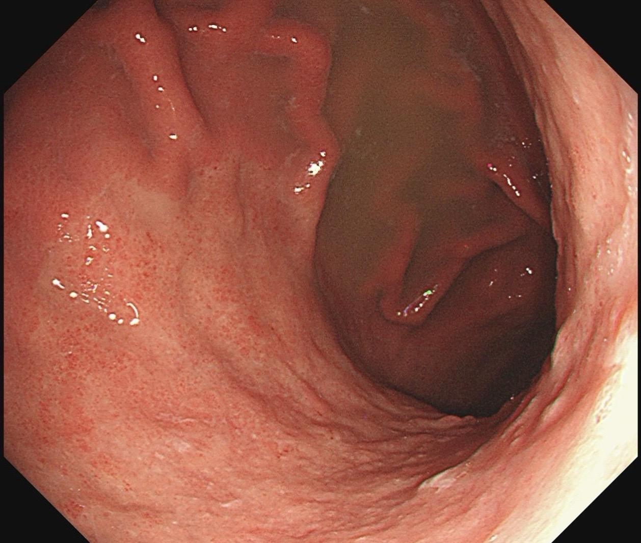 男，61岁，胃巨大褪色调病变。答案在最后一张图片，你猜对了吗？ 患者因...