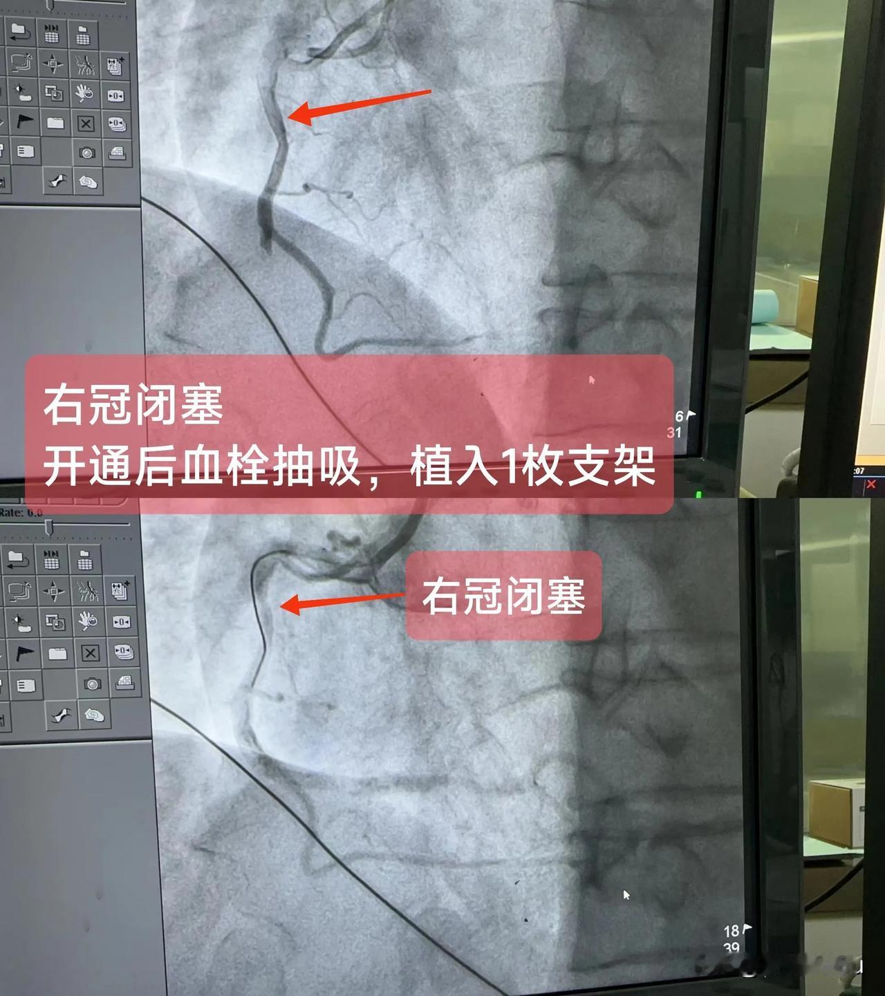 急性ST段抬高型心肌梗死
（右冠闭塞）
概念：右冠状动脉起自右冠窦，经肺动脉根部