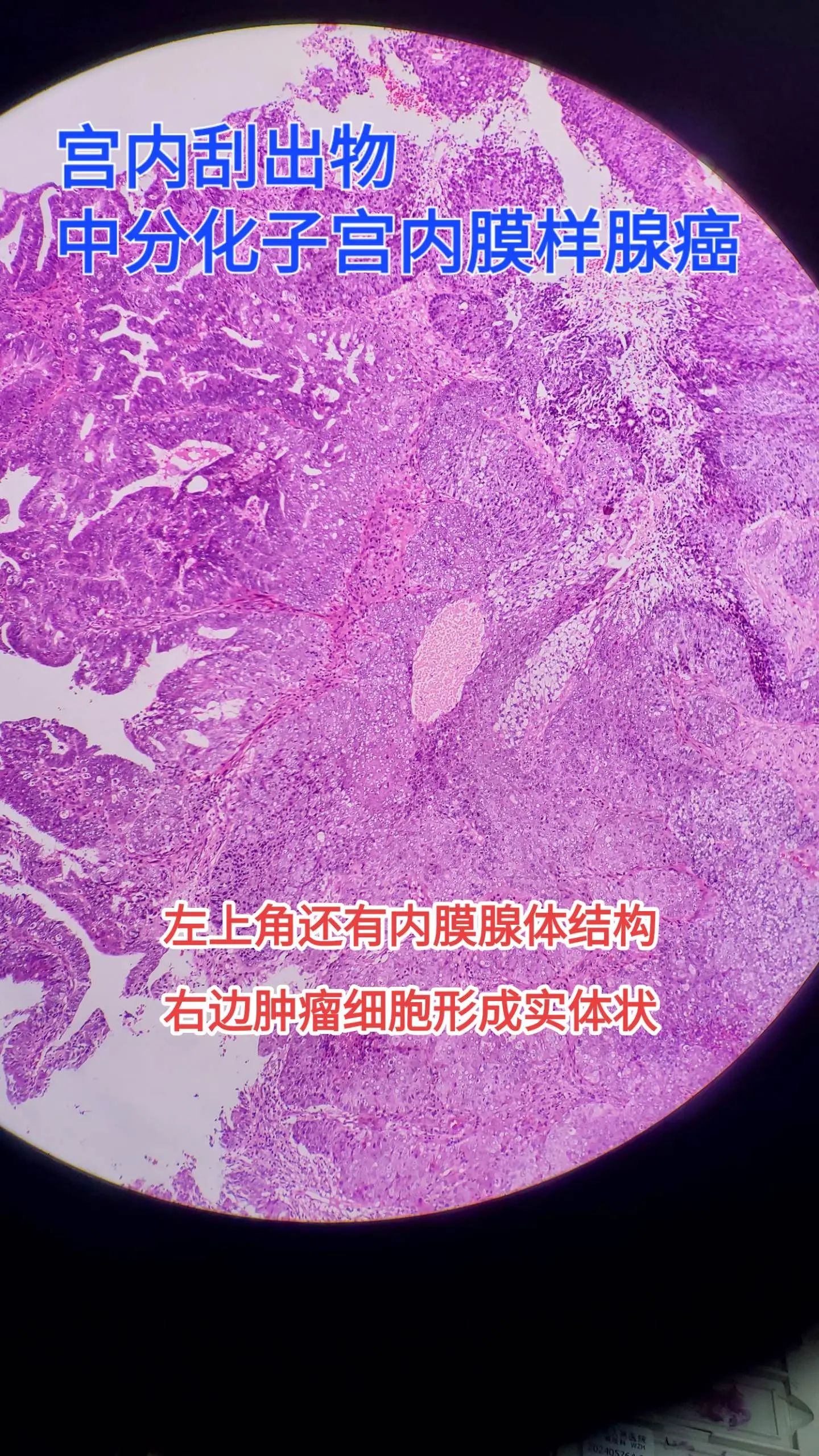 子宫内膜癌