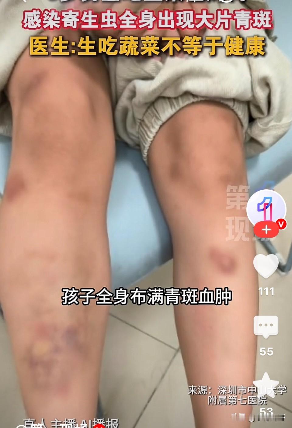 深圳，六岁男孩浑身出青斑血肿，家长以为孩子得了白血病赶紧住院治疗，医生经过反复检