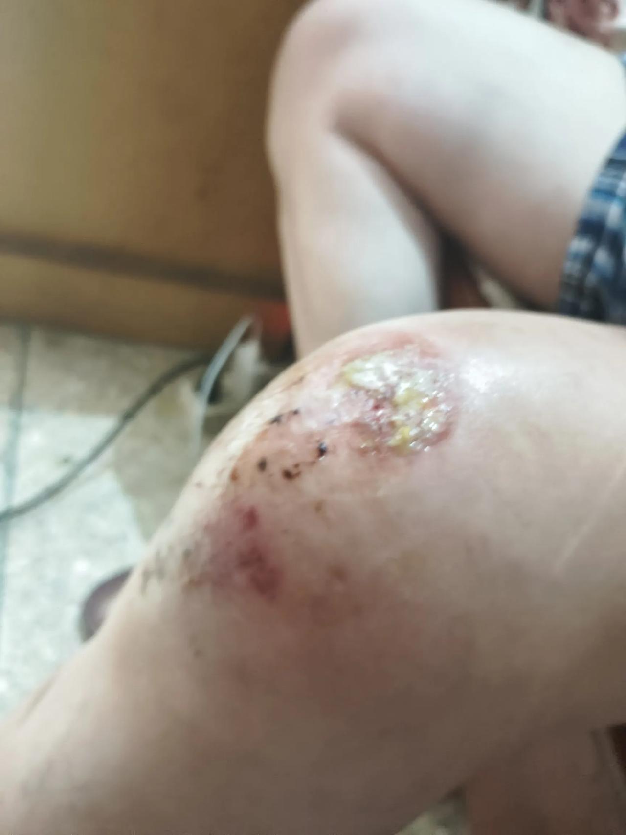 今天下午，老公打电话告诉我他摔伤了，摩托车也摔坏了，现在在修理铺，让我送点药膏过