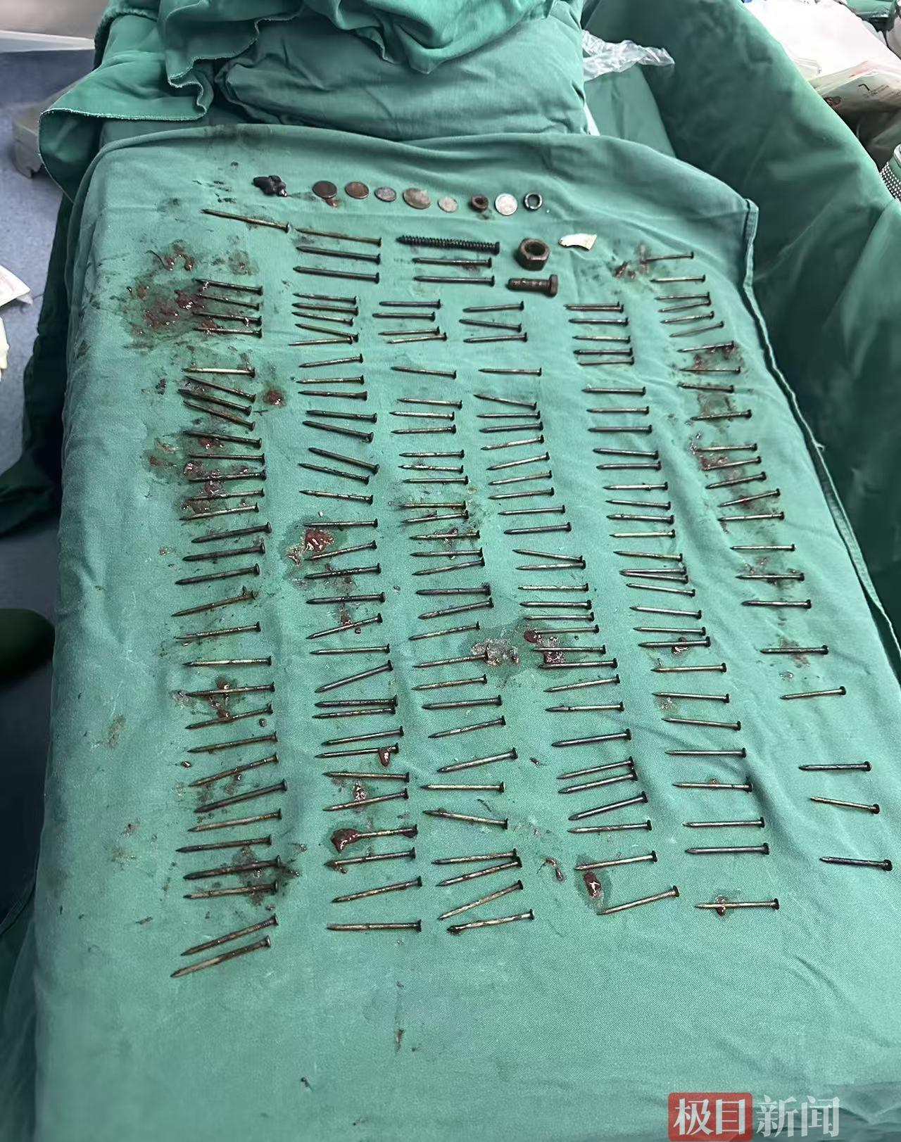 云南一中年男子胃里竟有180颗铁钉，这事儿太离谱了！近日，博主“肝胆胰外科李伟医