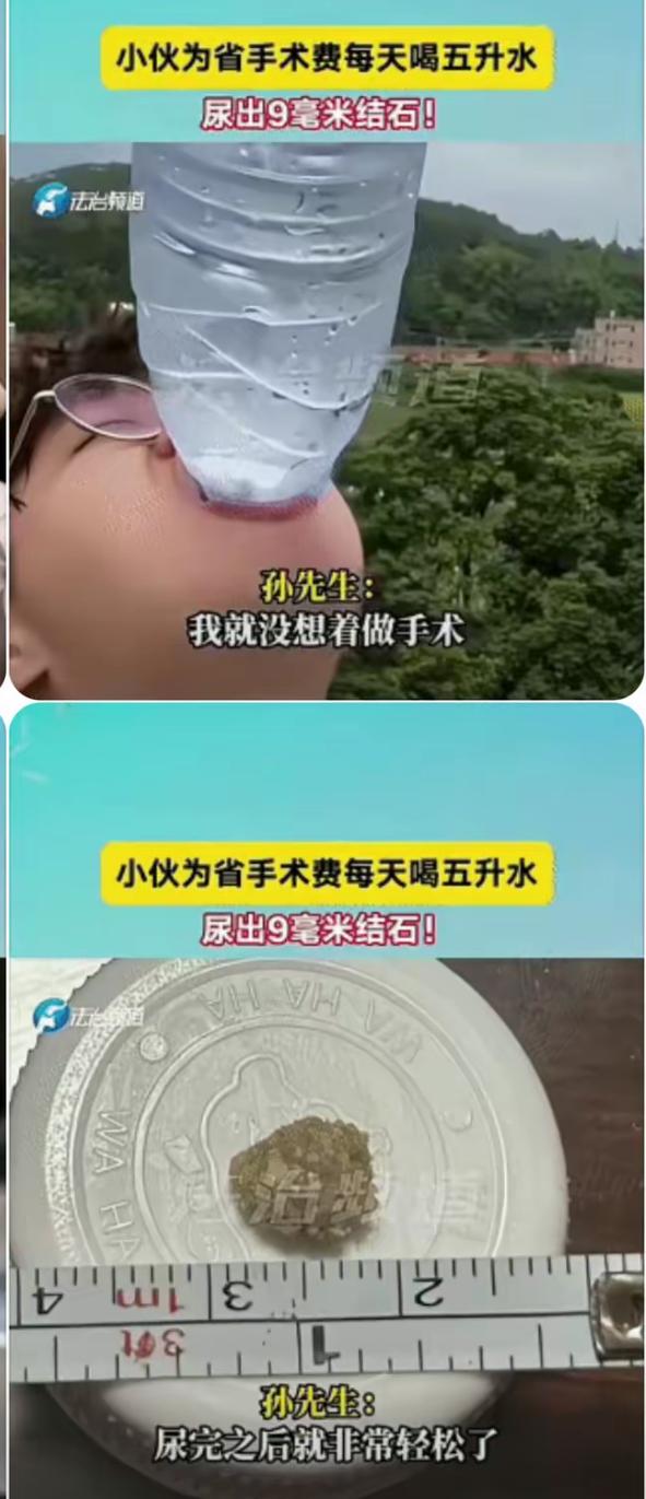 孙先生这操作太敢了！肾结石9毫米，嫌手术费一万多贵，竟每天灌5升水硬扛俩月，还真