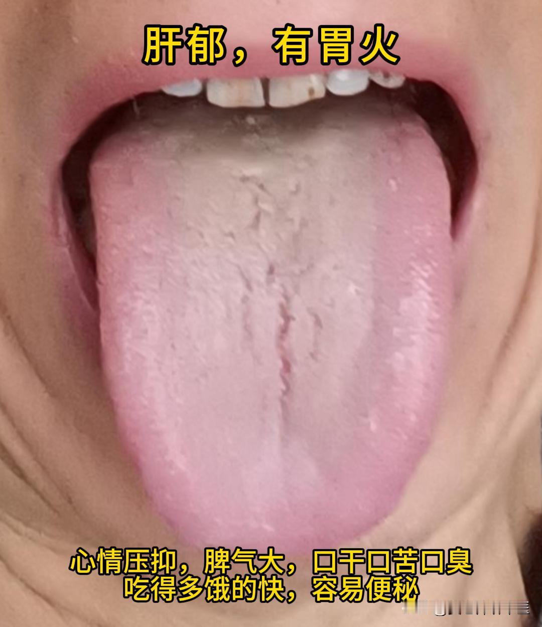 今天有时间，可以帮大家看看舌象。

有需要的，尽管把你的舌象照片发过来吧！越早发