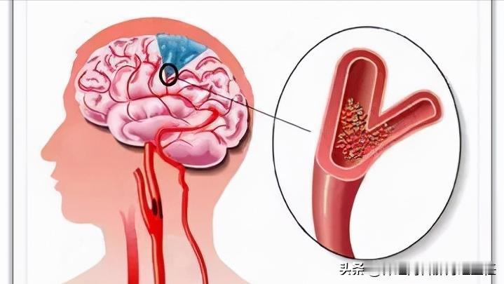发生脑梗，是不是把血管再“通开”就行了？
 
有朋友说，是不是脑梗就是血管堵了，