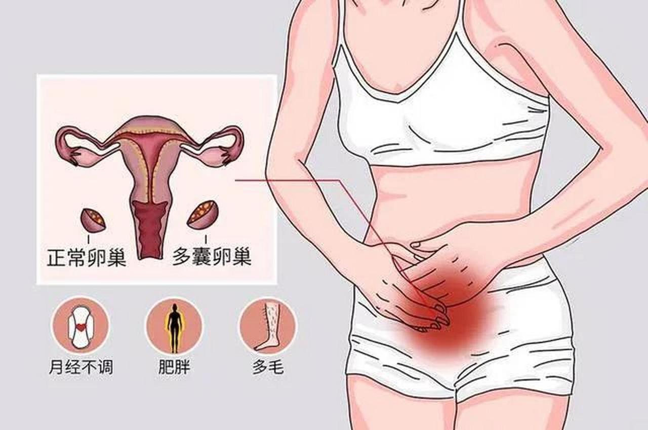 #健康真探社#【多囊卵巢在不同时期，应该如何调理？】多囊卵巢综合征（PCOS）是