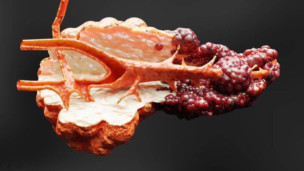 “胰腺癌”不声不响？提醒：有6个“前兆”，胰腺癌已经不远了

 胰腺癌虽然不常见
