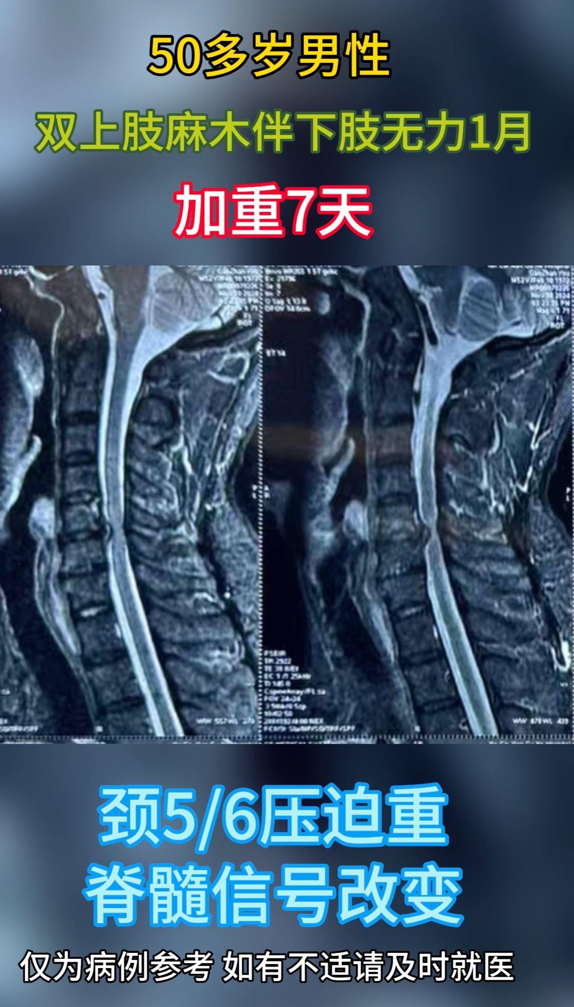 50多岁男性，双上肢麻木伴下肢无力1月，加重7天。术前磁共振显示颈5...